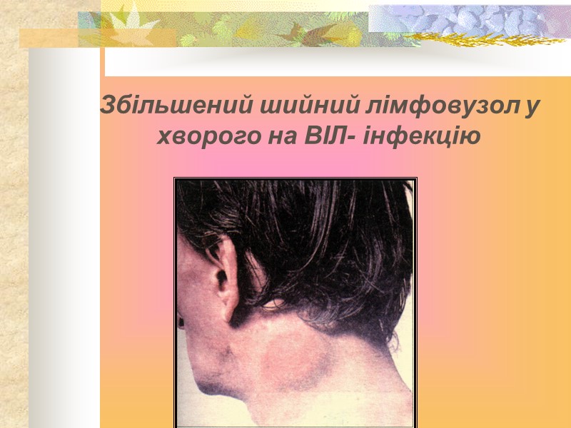 Збільшений шийний лімфовузол у хворого на ВІЛ- інфекцію